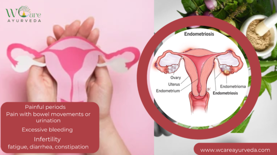 Managing Endometriosis for Better Fertility