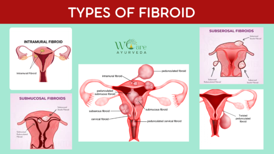 Fibroids and Their Impact on Fertility